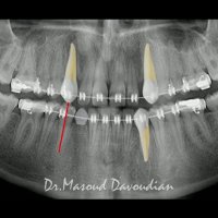 هدایت رویشی  نیش نهفته | دکتر داودیان