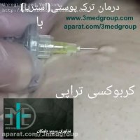 رفع ترک های پوستی با کربوکسی تراپی