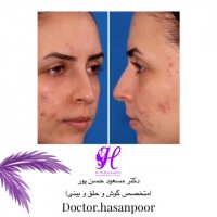 نمونه جراحی زیبایی بینی دکتر حسن پور