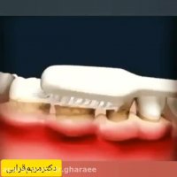 جرم گیری باعث لق شدن دندان می شود؟
