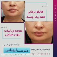 فیلم هایفوتراپی تنها در یک جلسه - معجزه لیفت بدون جراحی