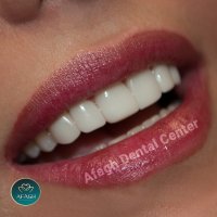 ونیر کامپوزیت