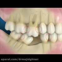 بهم ریختگی دندانها -دکترمجیدقیاسی دندانپزشک زیبایی مشهد