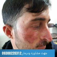 درمان بیماری لوپوس