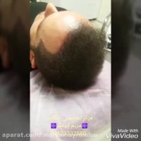 راه حلی قطعی برای رفع کم مویی آقایان حتی پس از کاشت مو