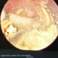 فیلم جراحی پیشرفته سنگ کلیه بدون برش