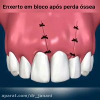 پیوند استخوان