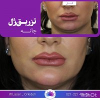 تزریق ژل چانه و زاویه سازی در کلینیک ارکیده