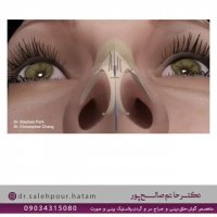 مراقبت های بعد از جراحی بینی