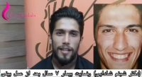 فیلم نتیجه عمل جراحی زیبایی بینی بعد از 7 سال