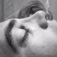 فیلم جراحی زیبایی بینی