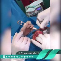 تعویض مفصل زانو در آرتروز شدید | دکتر مسعود صابری