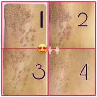 درمان زگیل تناسلی