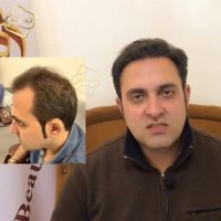 نطر مراجعین کاشت مو _ کلینیک رنسانس