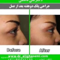 نمونه کار بلفاروپلاستی