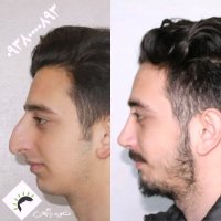 جراح بینی مشهد09380000893 | عکس قبل و بعد
