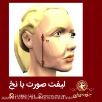 لیفت صورت با نخ