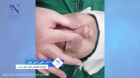 فیلم نتجه جراحی زیبایی بینی