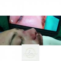 جراحی بینی در مردان