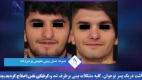 فیلم جراحی بینی طبیعی