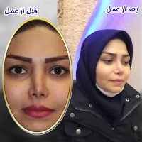 جراحی بینی ترمیمی | دکتر گلی