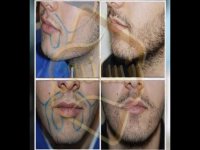 کاشت مو به روش SUT مرکز مو رنسانس