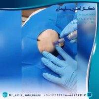 میکرونیدلینگ برای چه افرادی مناسب است