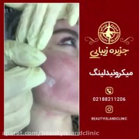نمونه کاری از میکرونیدلینگ - جزیره زیبایی
