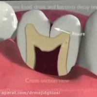 پوسیدگی دندان- دلایل افزایش و راهکارهای کاهش آن