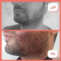 فیلم نتیجه کاشت ریش کم تراکم
