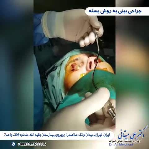 جراحی بینی به روش بسته