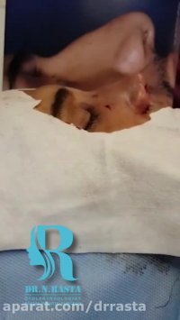 بینی گوشتی با انحراف و شکستگی