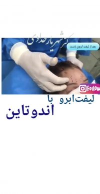 لیفت ابرو با اندوتاین