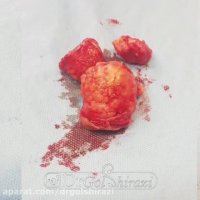 عمل میومکتومی در تهران