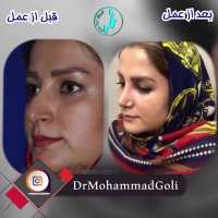 عمل زیبایی بینی | دکتر گلی بهترین جراح بینی تهران
