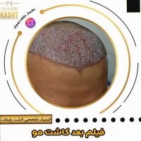 کاشت مو دائمی | کلینیک پایتخت | 44228594-021