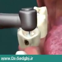 ترمیم با آمالگام