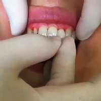 روکش دندان-مرکز دندانپزشکی فوق تخصصی ایمپلنت پردیس www.pardisdental.ir