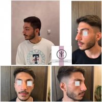 فیلم جراحی بینی مردانه