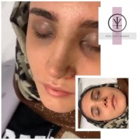 فیلم جراحی بینی استخوانی