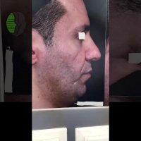 جراحی زیبایی بینی همزمان با آندوسکوپی سینوس | دکتر باستانی نژاد