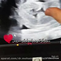 فیلم سونوگرافی شکم جنین