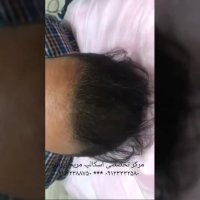 روش اسکالپ برای چه کسانی انجام میشود؟؟؟