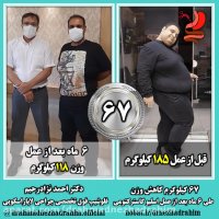 کاهش وزن 67 کیلوگرمی 6 ماه بعد از جراحی چاقی اسلیو معده