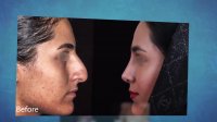 سه سال بعد از جراحی بینی | دکتر شهریار یحیوی