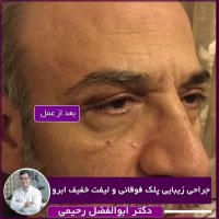 جراحی پلک فوقانی و لیفت ابرو به مقدار خفیف
