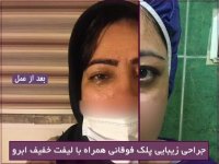 بلفاروپلاستی پلک فوقانی با لیفت خفیف ابرو