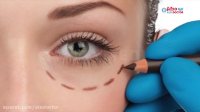 نکاتی درباره عمل جراحی بینی و پلک