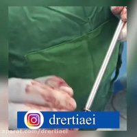 جراحی دیسک گردن