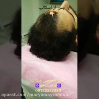 افزایش تراکم در فضاهای خالی سر